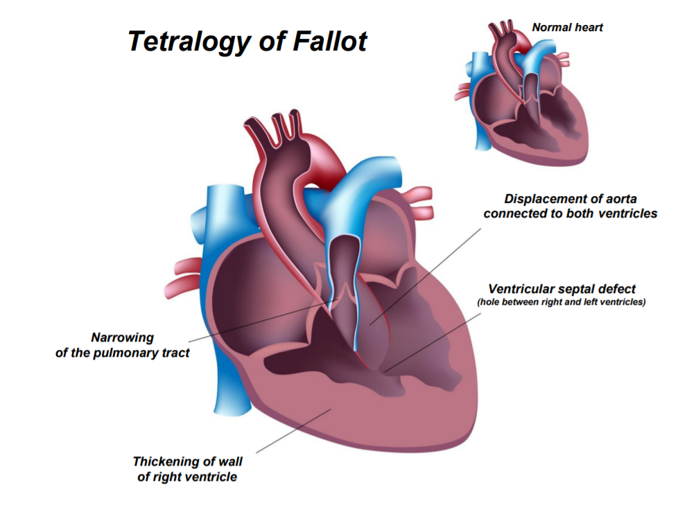 tetralogy-of-fallot